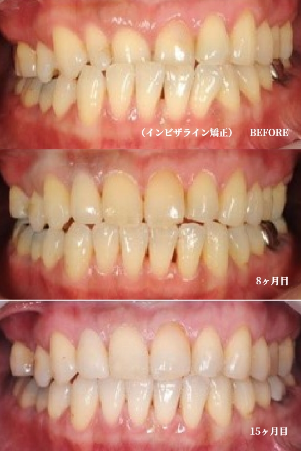 治療前(左)と2回目の治療後(中央)と3回目の治療後(右)